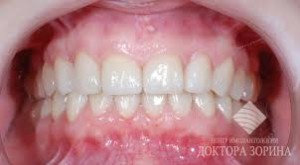 Photo: dents après l'installation des facettes