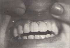 Photo: prothèse adhésive installée