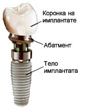 Photo: apparence de l'implant