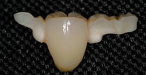 Photo: prothèse adhésive