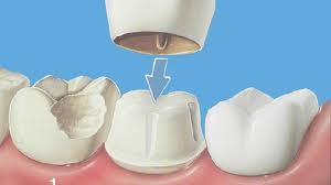 Photo: couronne de dents correctement affûtée