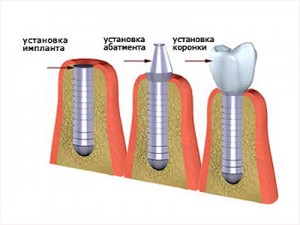 Photo: étapes de pose de l'implant