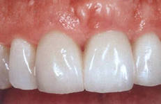 Photo: prothèses sans tourner les dents