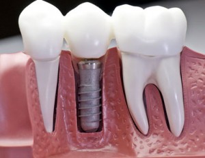 Photo: implant installé