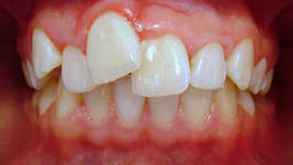 Photo: Manifestation de malocclusion