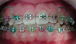 Photo: Bretelles pour corriger une malocclusion chez un enfant