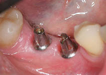 Photo: prothèses implantaires