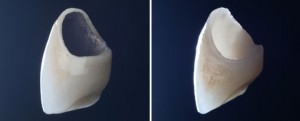 Photo: couronnes métal-céramique et tout céramique