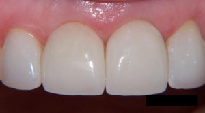 Photo: couronnes sur les dents de devant