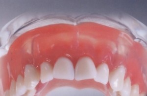 Photo: Prothèse en nylon