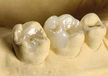 Photo: onglet prothèses