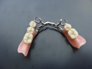 Photo: Prothèse à fermoir avec fermoirs