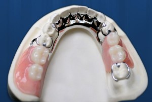 Photo: Prothèse à fermoir sur la mâchoire inférieure