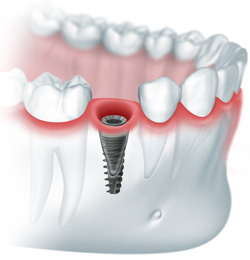 Photo: implant installé