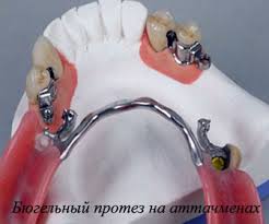 Photo: Prothèse de fermoir sur les attachements