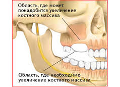 Photo: Atrophie osseuse au site d'implantation