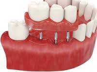 Photo: implantation basale