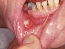 Photo: Le processus inflammatoire de la muqueuse buccale