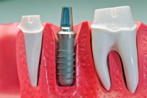 Photo: implant installé