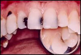 Photo: Dents touchées par la carie