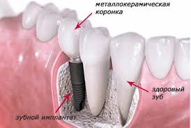 Photo: implant installé avec couronne