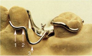 Photo: Éléments de base d'un fermoir métallique à un bras