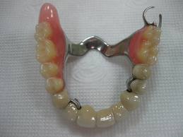 Photo: Bande palatine transversale