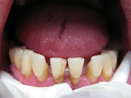 Photo: Exposition des racines des dents