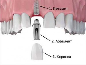 Photo: Structure de l'implant