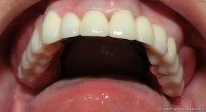 Photo: Esthétique d'une prothèse de voûte plantaire sur attachements