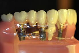 Foto: implants d’arrel