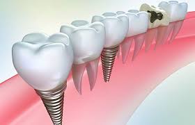 Photo: implants radiculaires