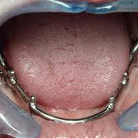 Foto: implantació subperiosteal