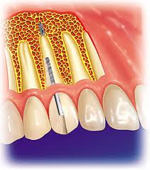 Foto: Endodonto - implantació endossal