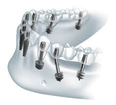 Foto: implantació basal