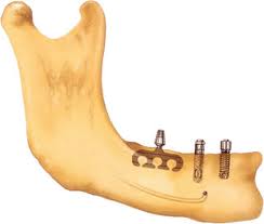 Foto: implants intraososos