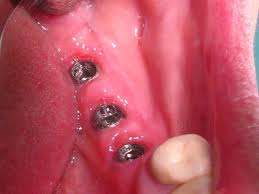 Photo: Implantation en présence d'un défaut d'extrémité dans la dentition