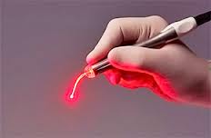 Foto: implantació làser
