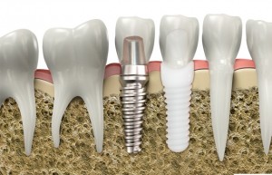 Photo: Implants en titane et zirconium