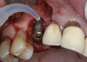 Photo: implantation