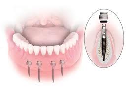 Foto: Mini implants