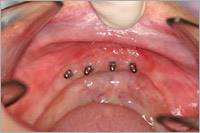 mini implantation avant