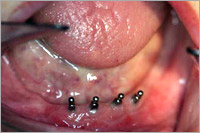 mini implantation avant