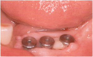 Photo: Exposition de trois implants