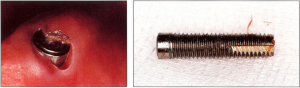 Photo: rejet de l'implant