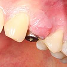 Photo: réimplantite