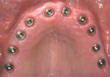 Photo: implantation complète des dents dans la mâchoire supérieure
