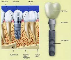Photo: Structure de l'implant