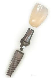 Foto: Estructura dels implants