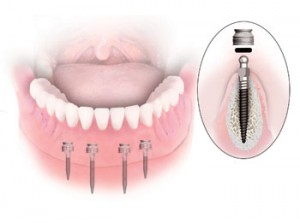 Photo: Voici à quoi ressemble un mini implant